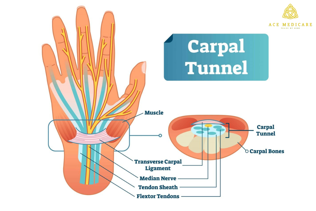 Debunking Common Myths About Carpal Tunnel Syndrome